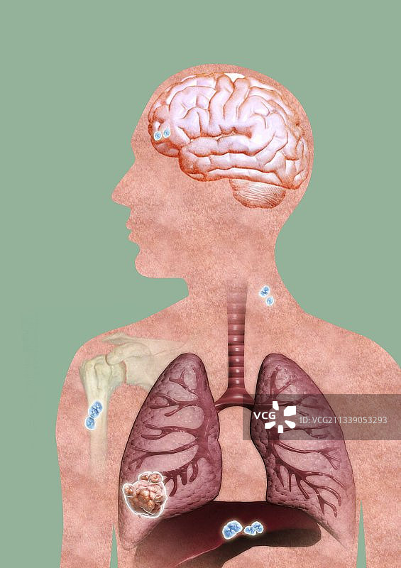 转移性癌症，艺术作品图片素材