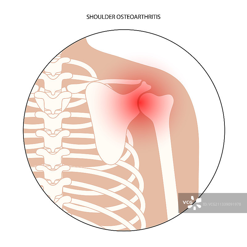 肩部疼痛概念图片素材