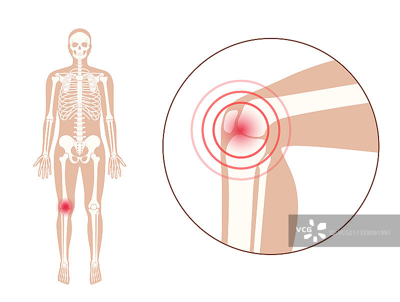 膝关节疼痛图片素材