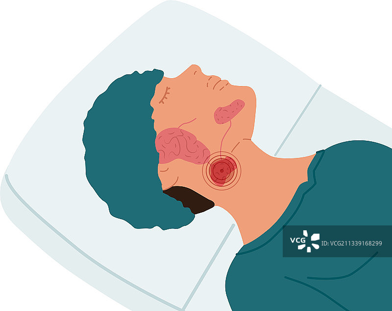 颌下腺疾病患者图片素材