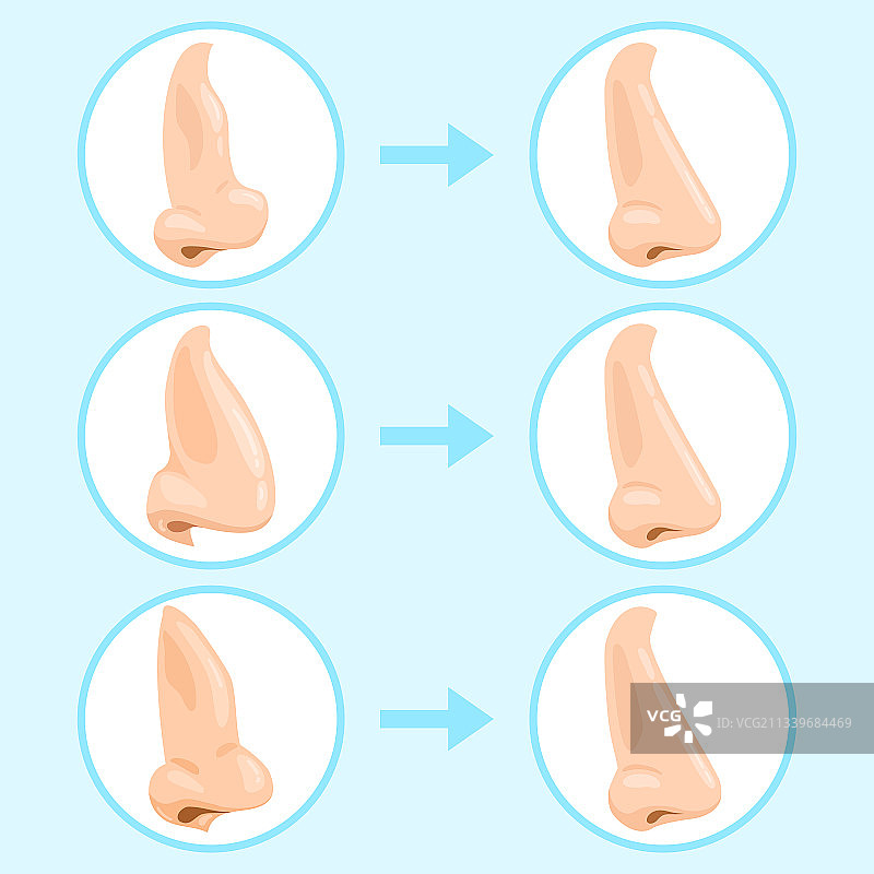 卡通隆鼻手术前后图片素材