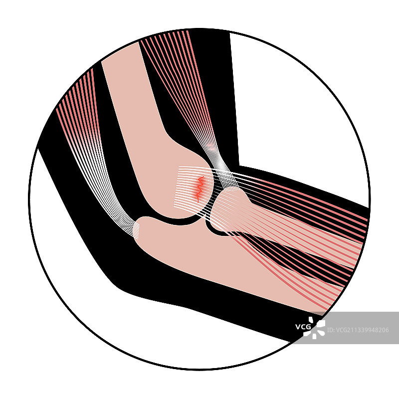 肱骨外上髁炎网球肘图片素材