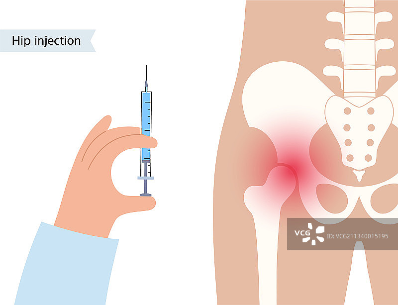 髋关节注射图片素材