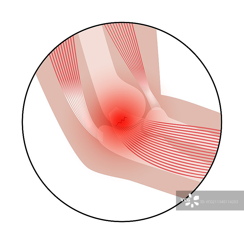 内侧上髁炎（高尔夫球肘）图片素材