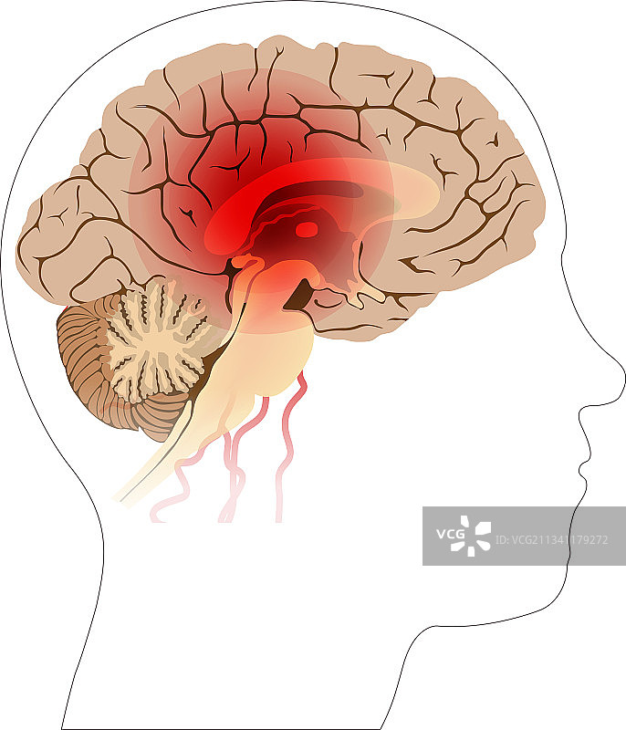 脑栓塞治疗医学案例图片素材