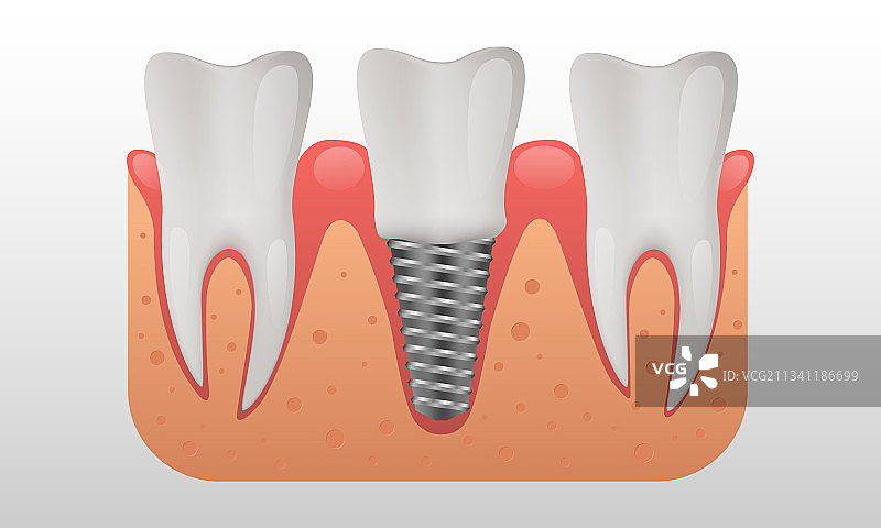 牙科种植体结构、人类牙齿图片素材