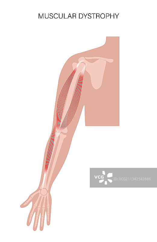 肌肉萎缩的手臂图片素材
