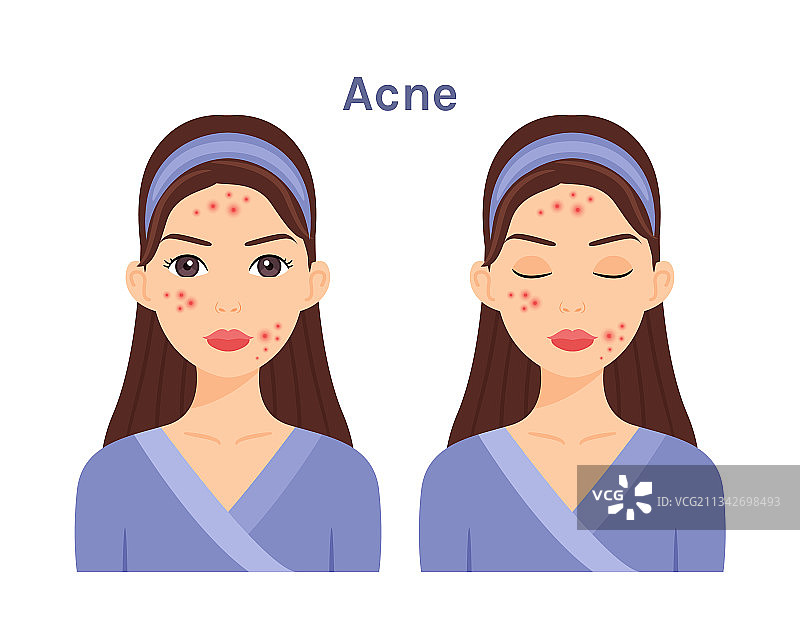 有粉刺问题的漂亮女人图片素材