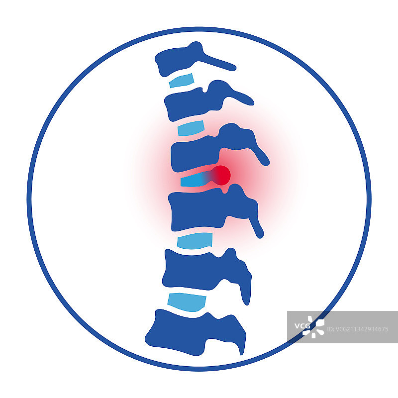 椎间盘突出概念图片素材