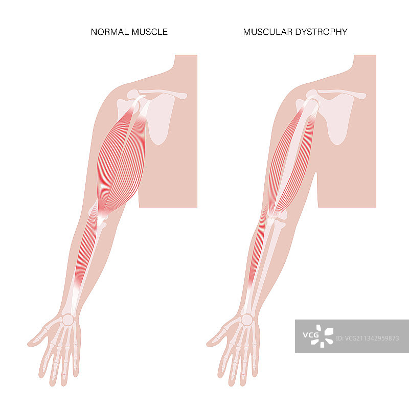 肌肉萎缩的手臂图片素材