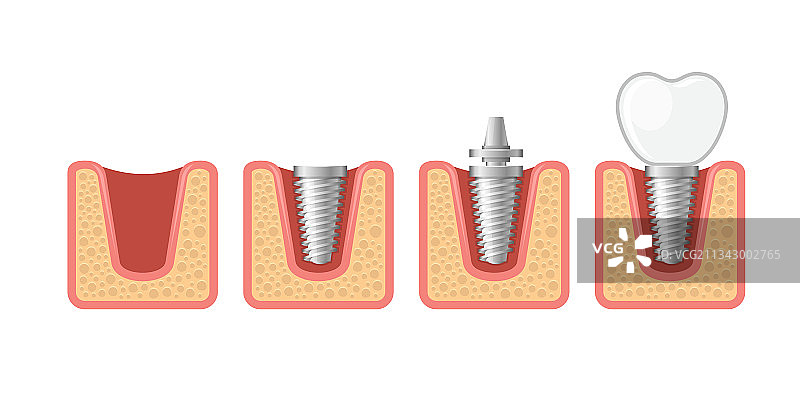 牙科植入物与人类牙齿组合图片素材