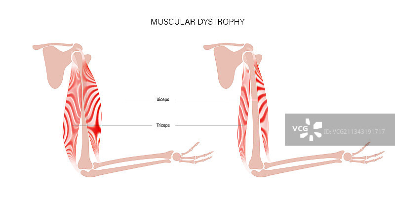 肌肉萎缩的手臂图片素材