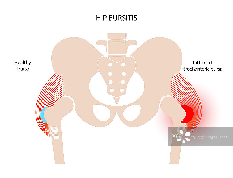 滑囊炎炎症概念图片素材