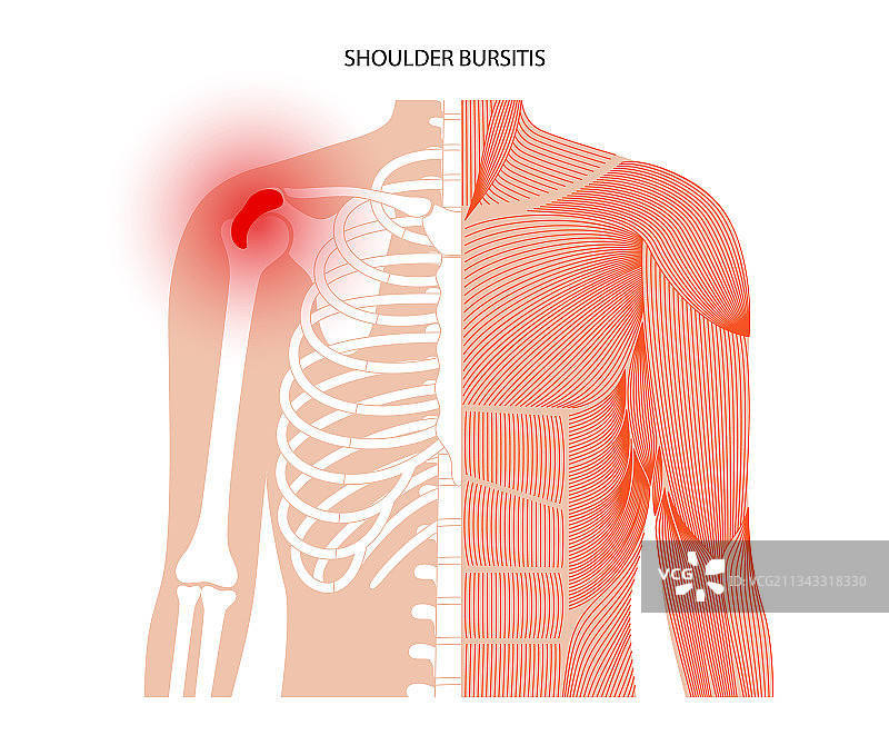 滑囊炎炎症概念图片素材