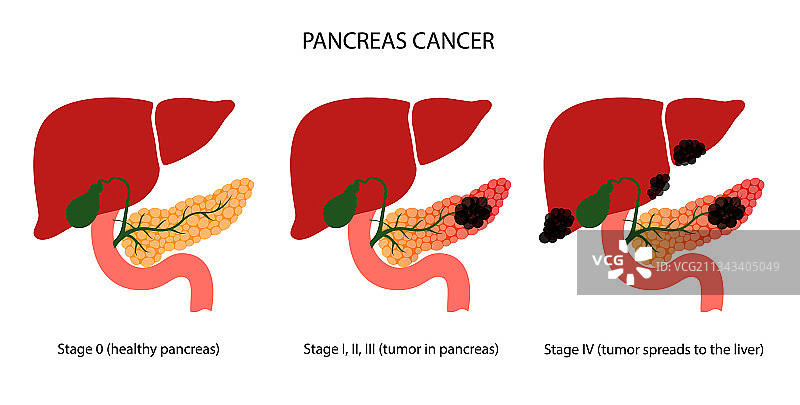 胰腺疾病与癌症图片素材