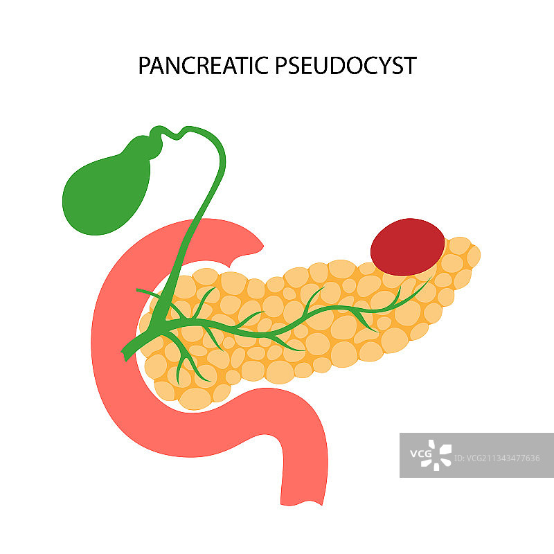 胰腺疾病与癌症图片素材