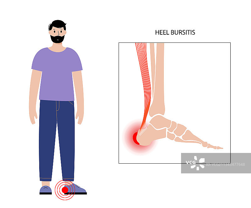 滑囊炎炎症概念图片素材