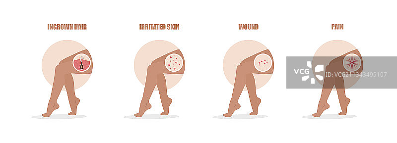 脱毛问题：毛发内生，皮肤刺激图片素材