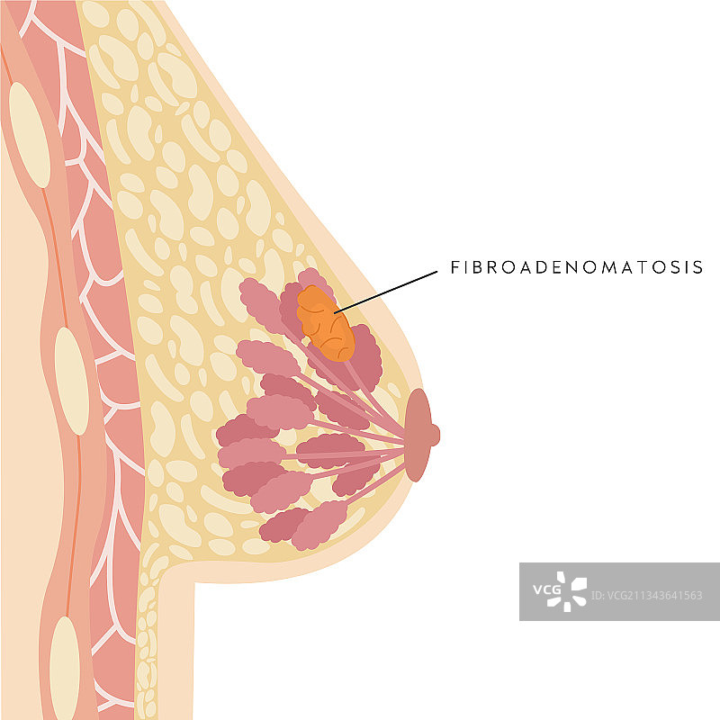 女性乳房横截面医疗信息图图片素材