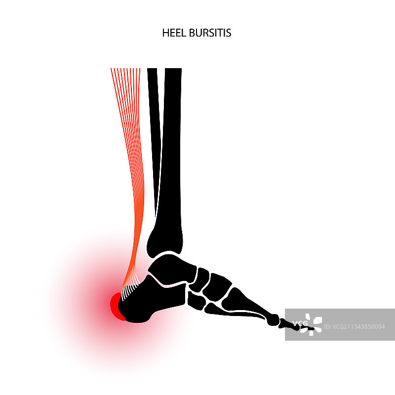 滑囊炎炎症概念图片素材
