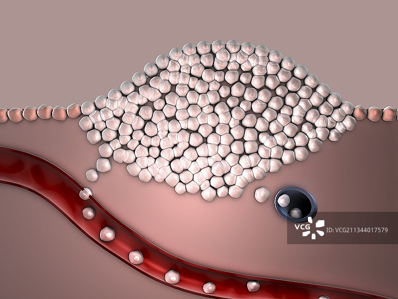 转移性癌症，艺术作品图片素材