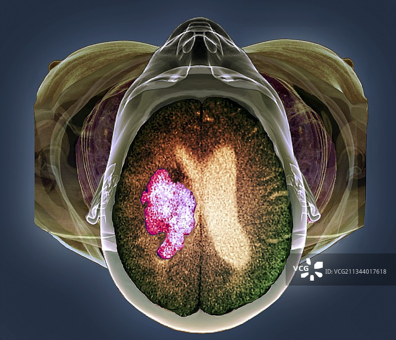 中风、MRI和3D CT扫描图片素材