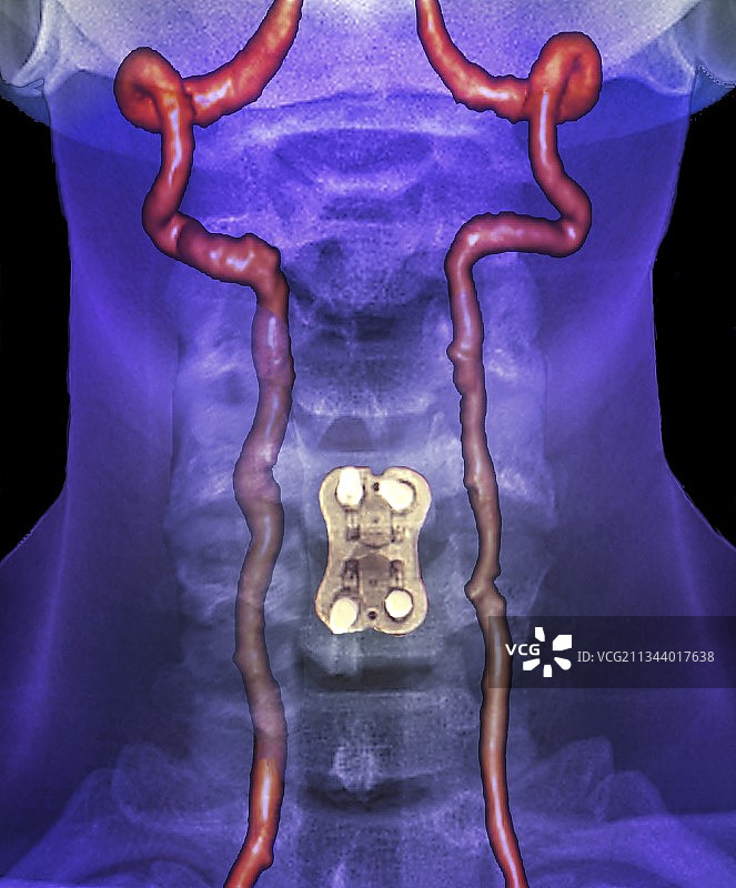 颈部关节炎治疗，血管造影图片素材