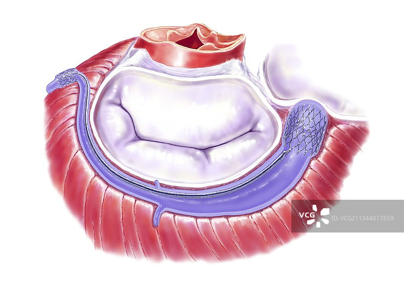 二尖瓣环成形术，艺术作品图片素材