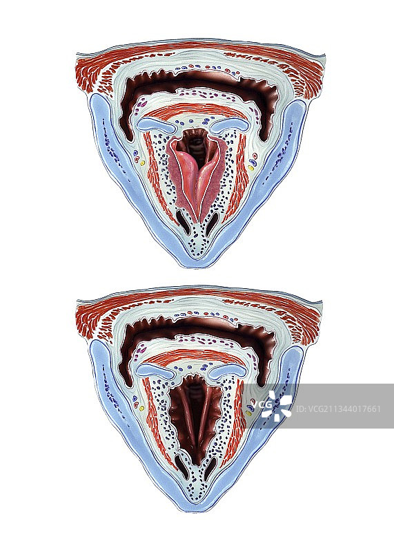 喉头水肿，艺术作品图片素材