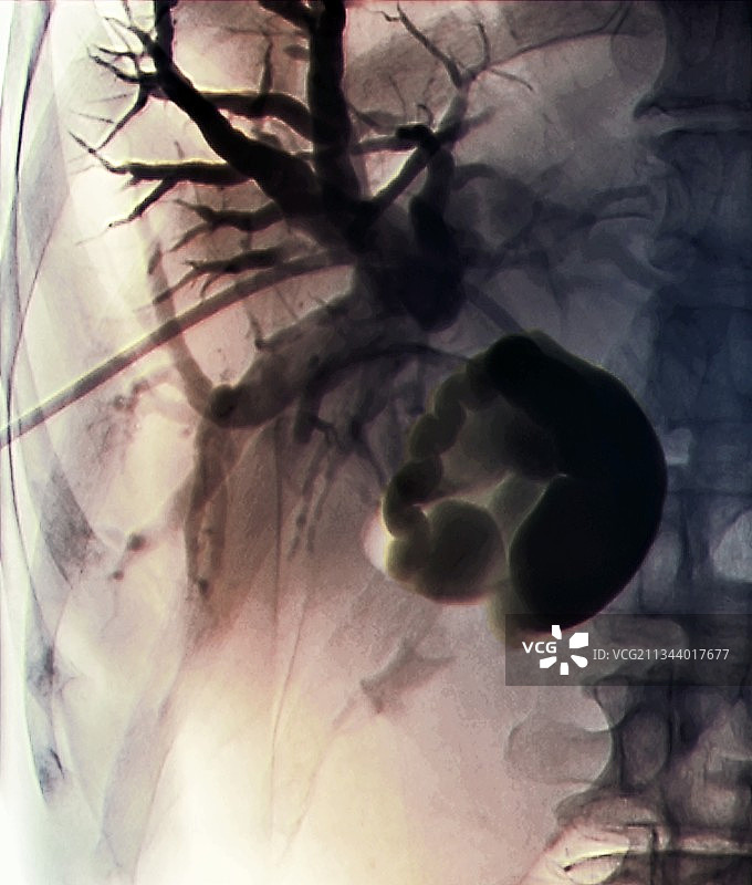 胆道引流X光片图片素材