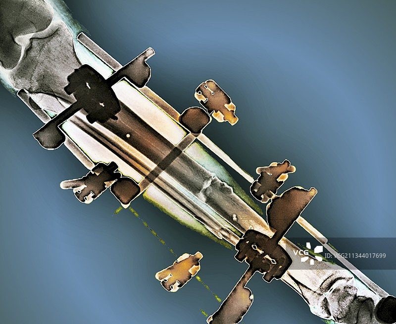 股骨骨折X光片图片素材