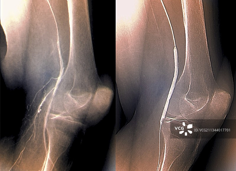 球囊血管成形术X光片图片素材