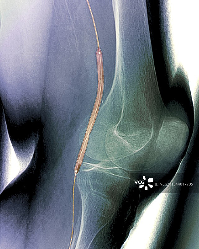 球囊血管成形术X光片图片素材