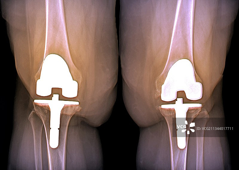 膝关节假体与肥胖X光片图片素材