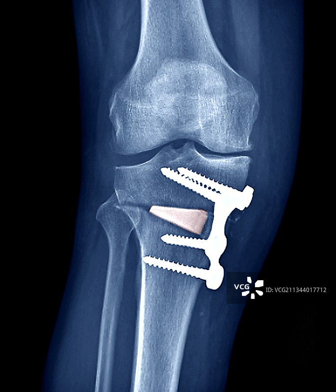 膝关节复位手术X光片图片素材