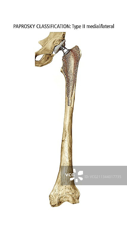 Paprosky股骨缺损II型（内外侧）图片素材