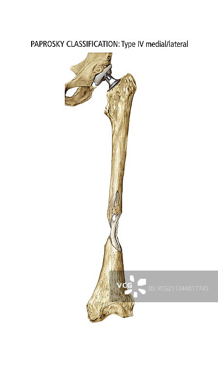 Paprosky股骨缺损IV型内-外侧图片素材