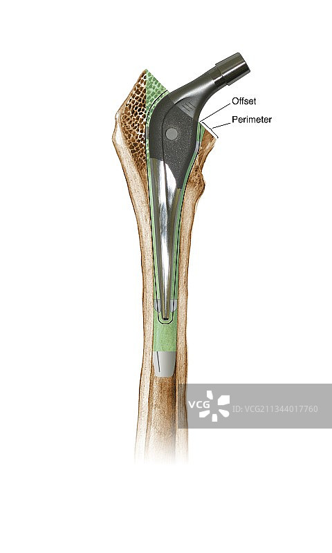 假肢髋关节图图片素材