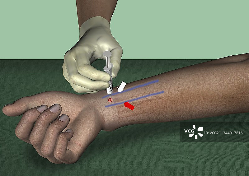 正中神经腕管阻滞图片素材