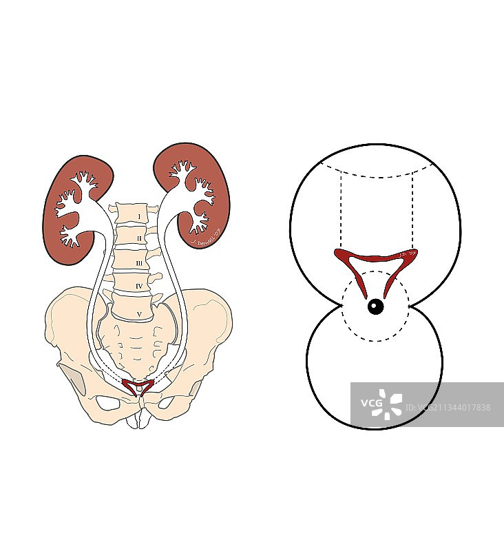 尿失禁手术，艺术作品图片素材