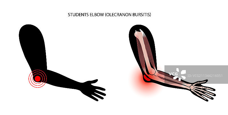 学生肘部滑囊炎图片素材