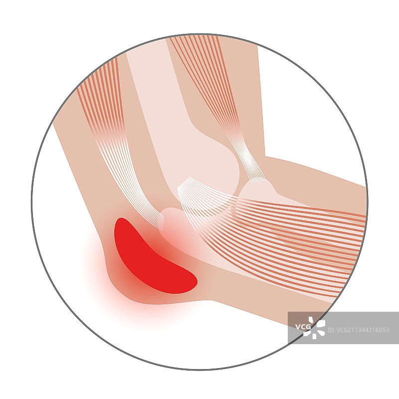 学生肘部滑囊炎图片素材