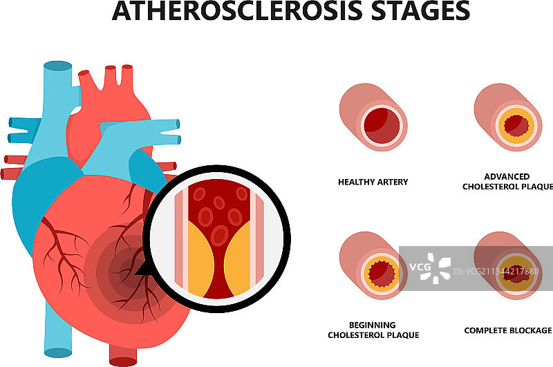 含动脉粥样硬化斑块的人体心脏解剖图图片素材