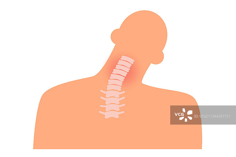 颈椎病相关部位矢量插画图片素材