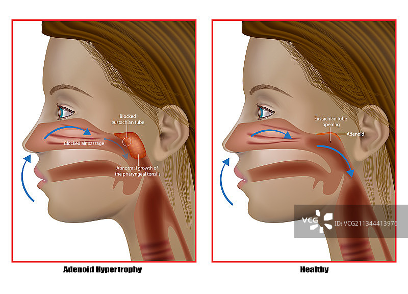 腺样体肥大异常生长图片素材