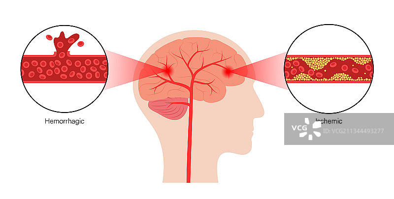 缺血性和出血性脑卒中图片素材