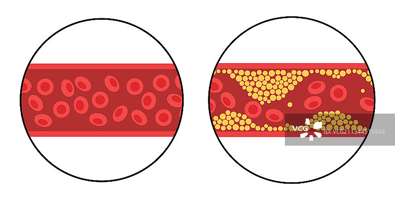 胆固醇与动脉粥样硬化图片素材