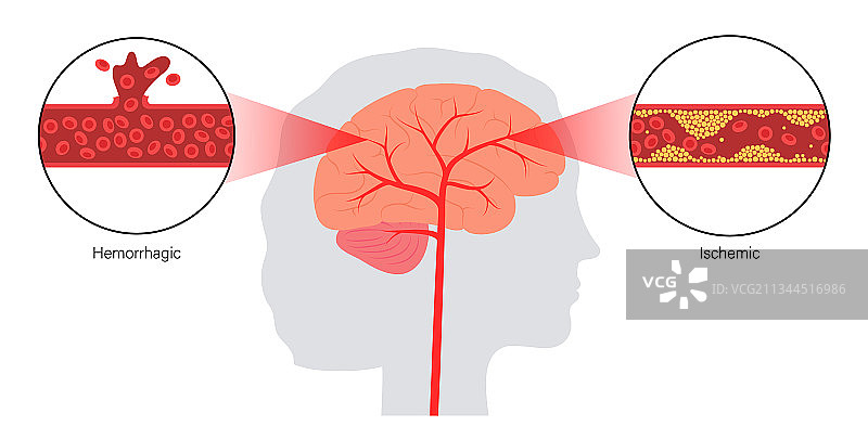 缺血性和出血性脑卒中图片素材