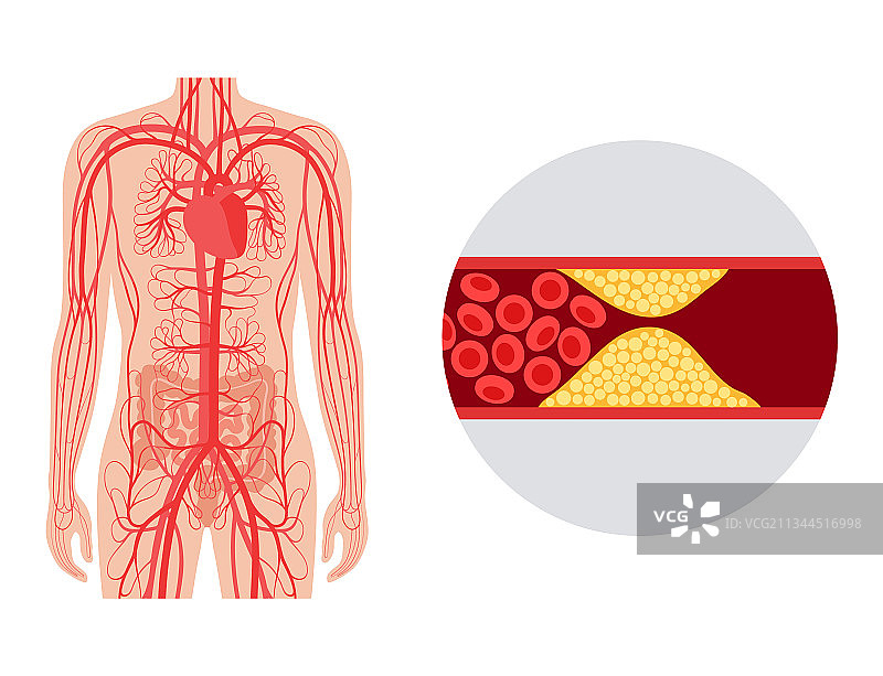 肠系膜缺血图片素材