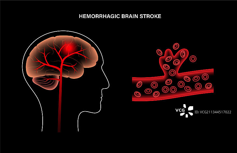 出血性脑卒中图片素材